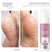 Anti Callus Master 200ml